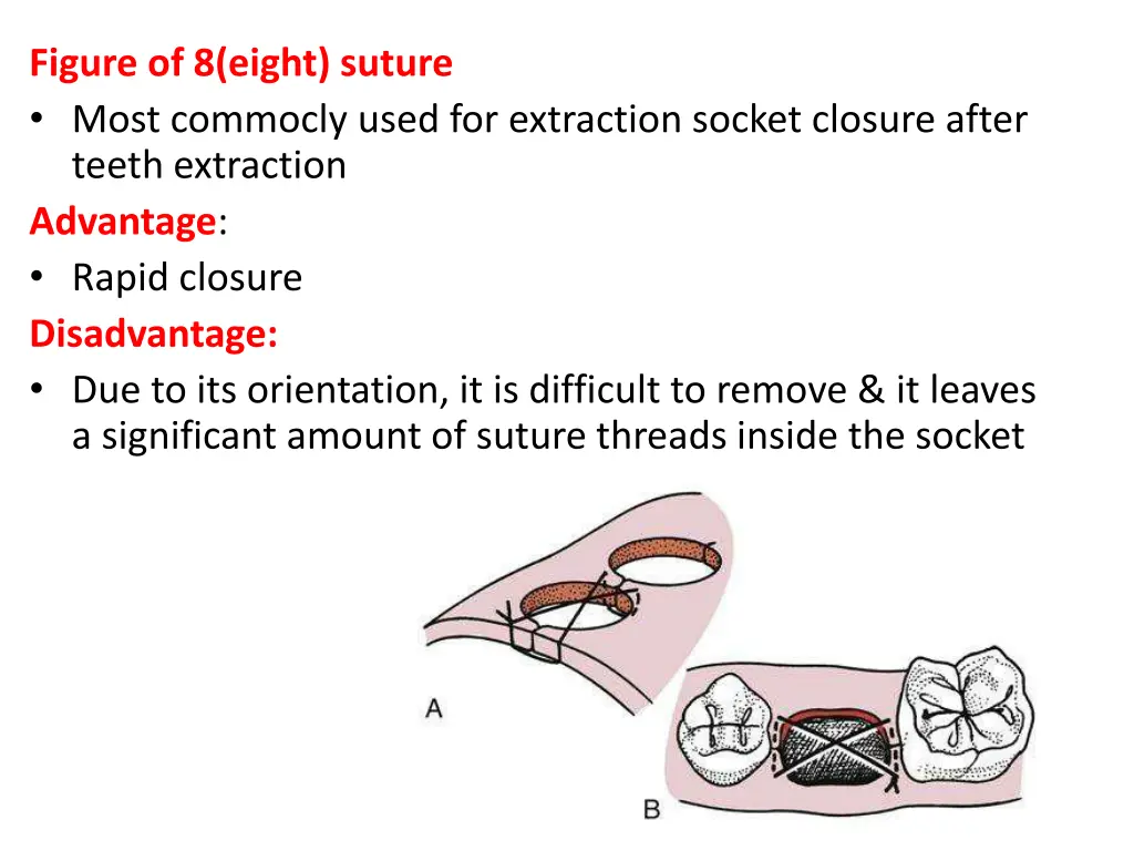 figure of 8 eight suture most commocly used