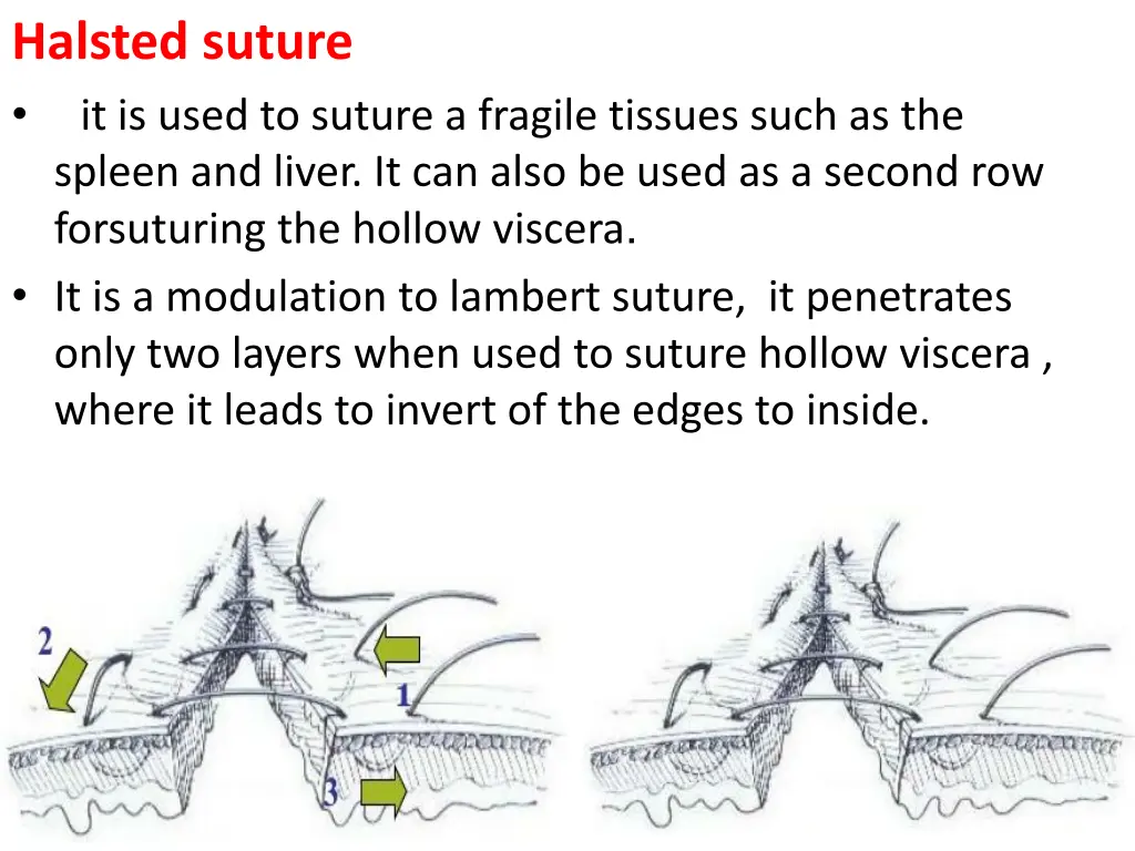 halsted suture it is used to suture a fragile