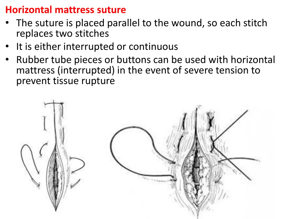 horizontal mattress suture the suture is placed