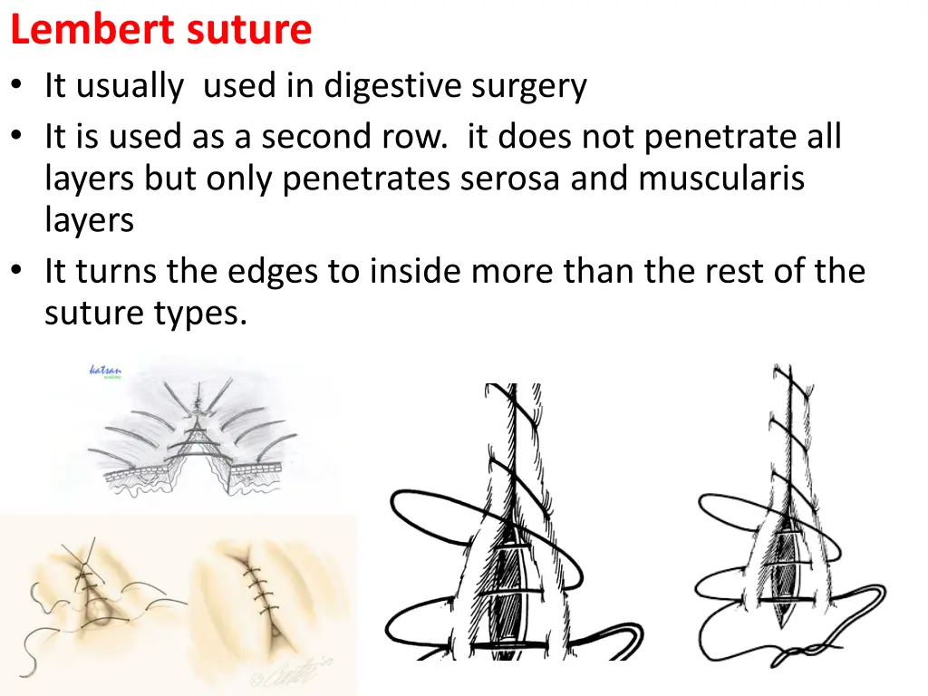 lembert suture it usually used in digestive