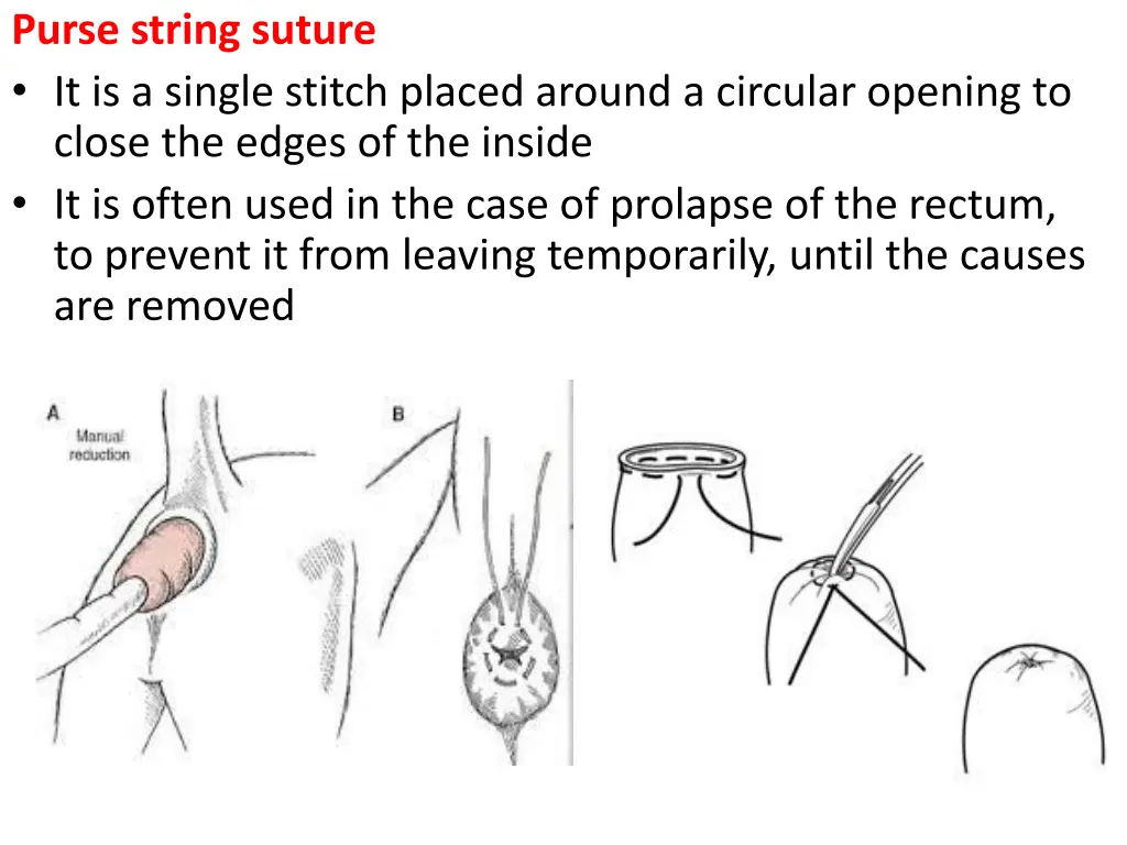 purse string suture it is a single stitch placed