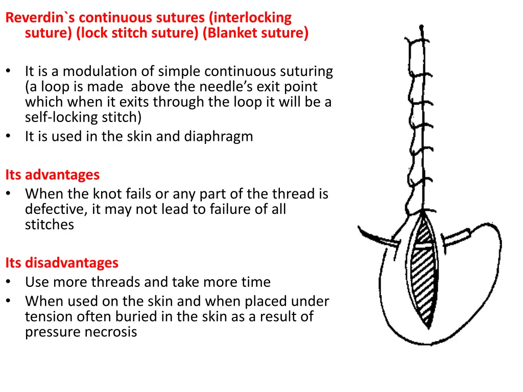 reverdin s continuous sutures interlocking suture