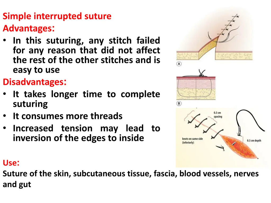 simple interrupted suture advantages in this