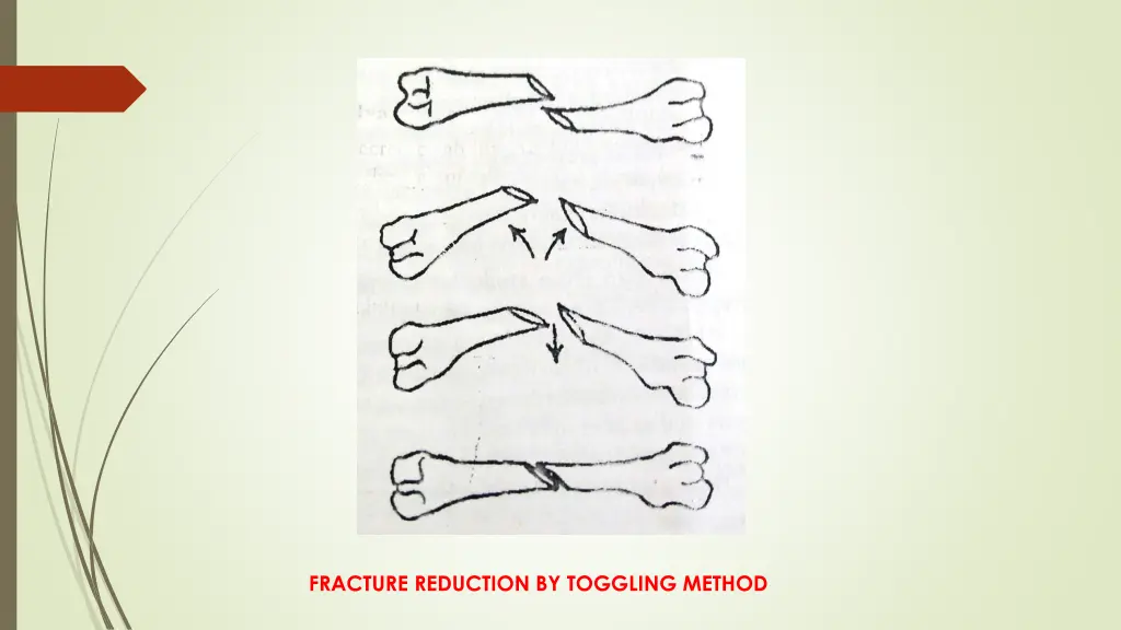 fracture reduction by toggling method