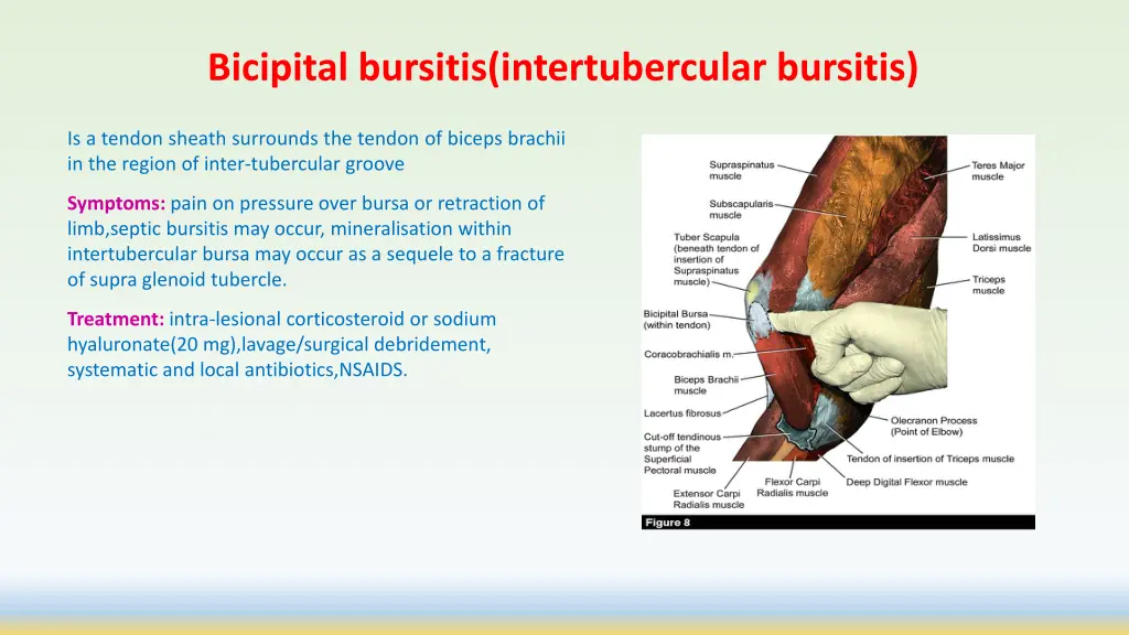 bicipital bursitis intertubercular bursitis