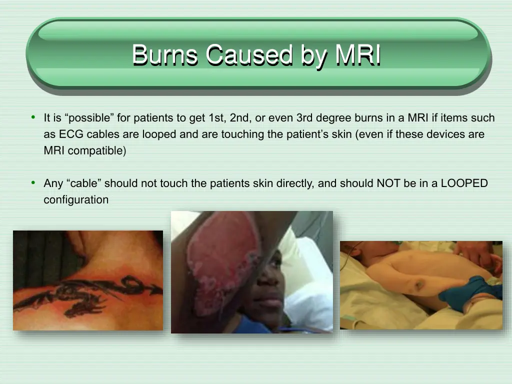 burns caused by mri