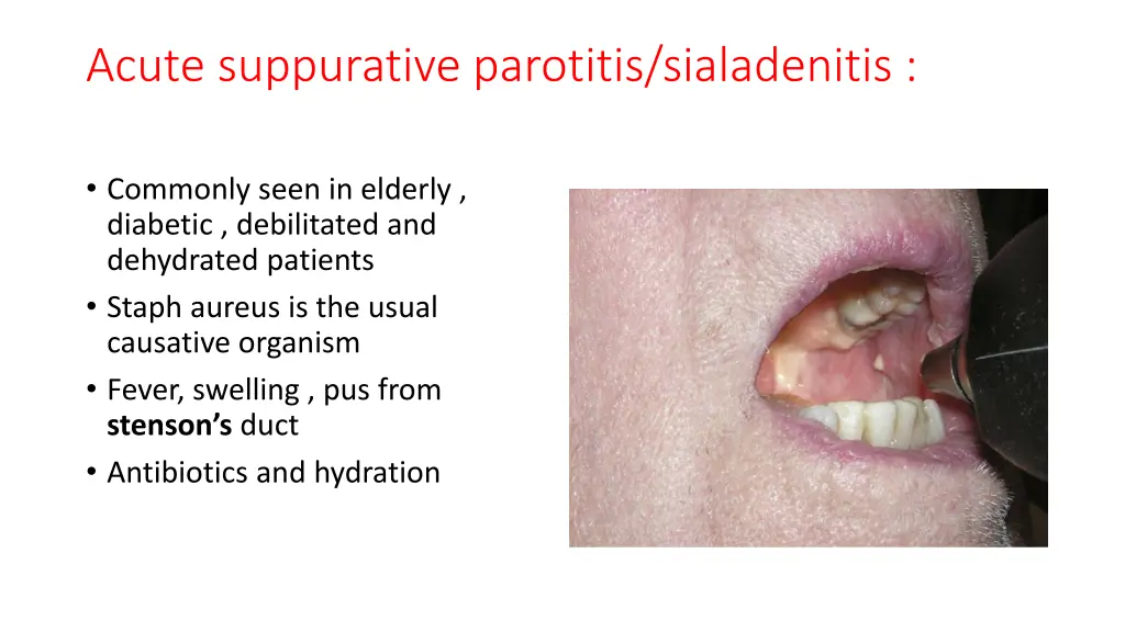 acute suppurative parotitis sialadenitis