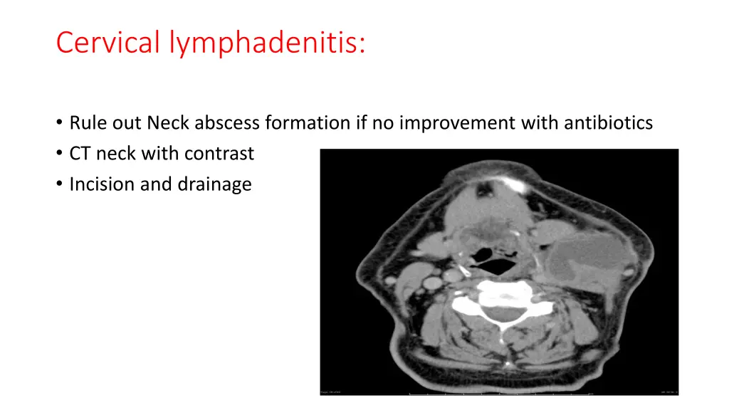 cervical lymphadenitis 1