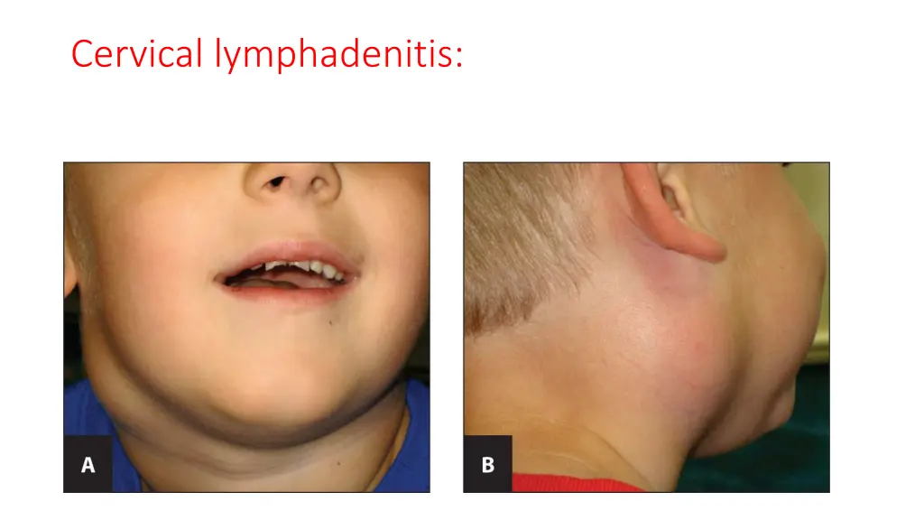 cervical lymphadenitis