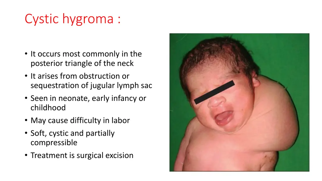 cystic hygroma