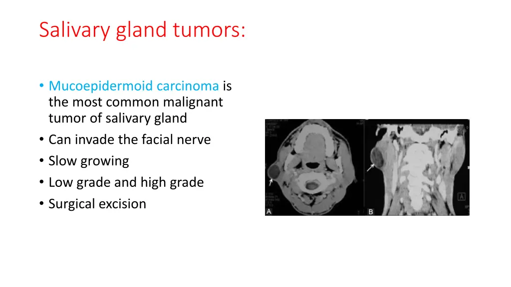 salivary gland tumors 1