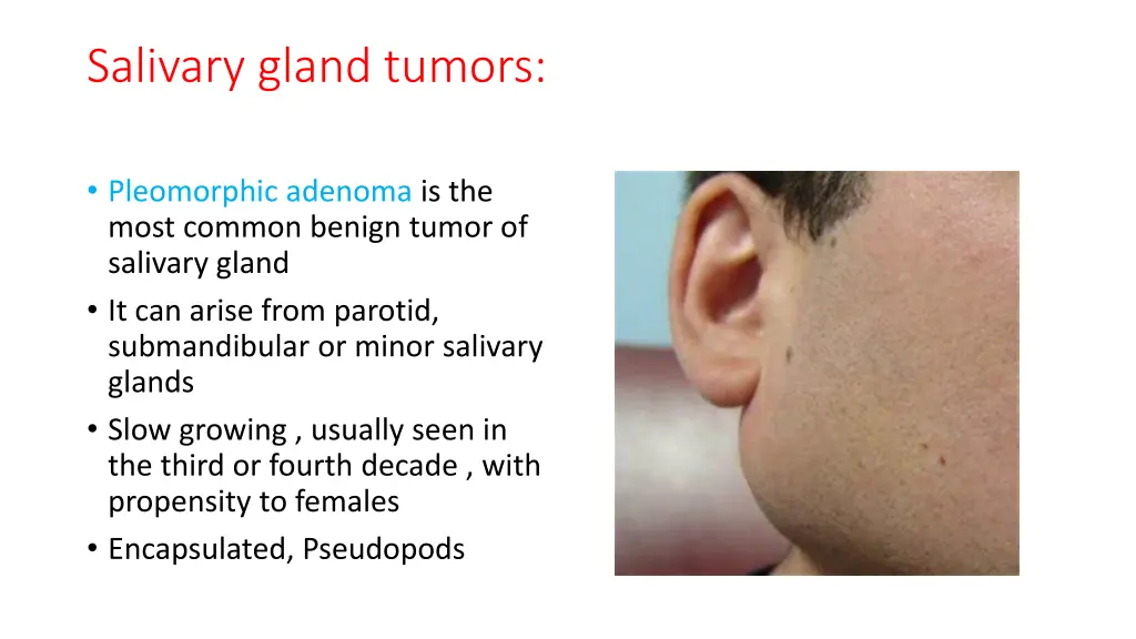 salivary gland tumors