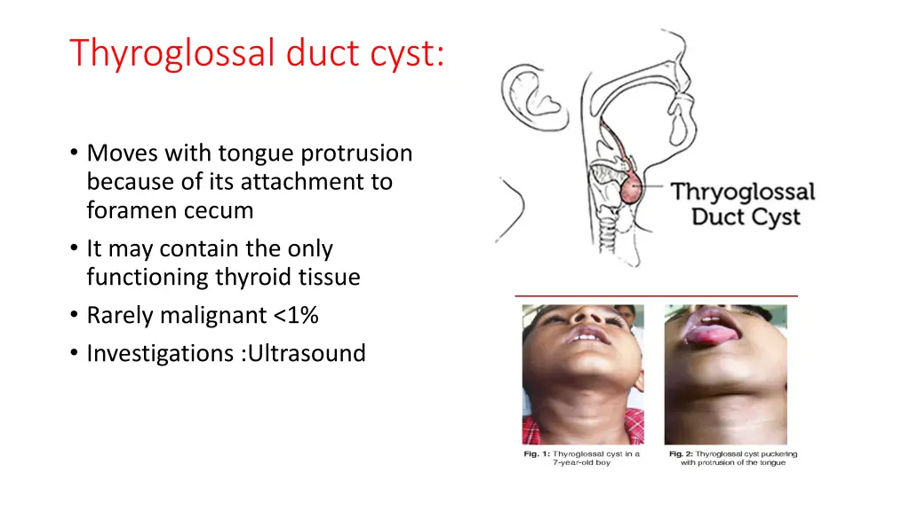 thyroglossal duct cyst 1