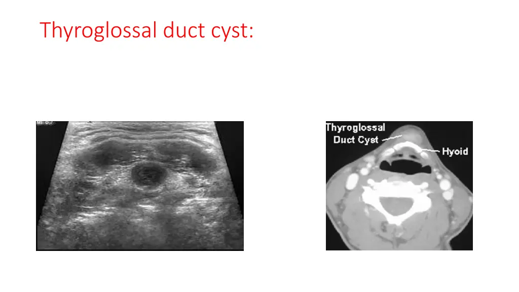 thyroglossal duct cyst 2