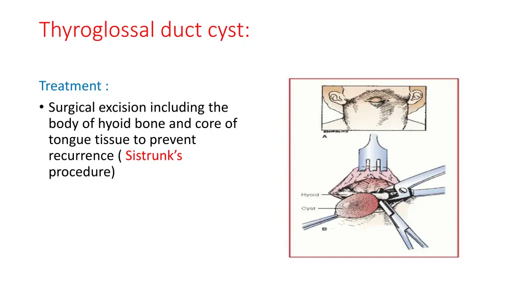 thyroglossal duct cyst 3