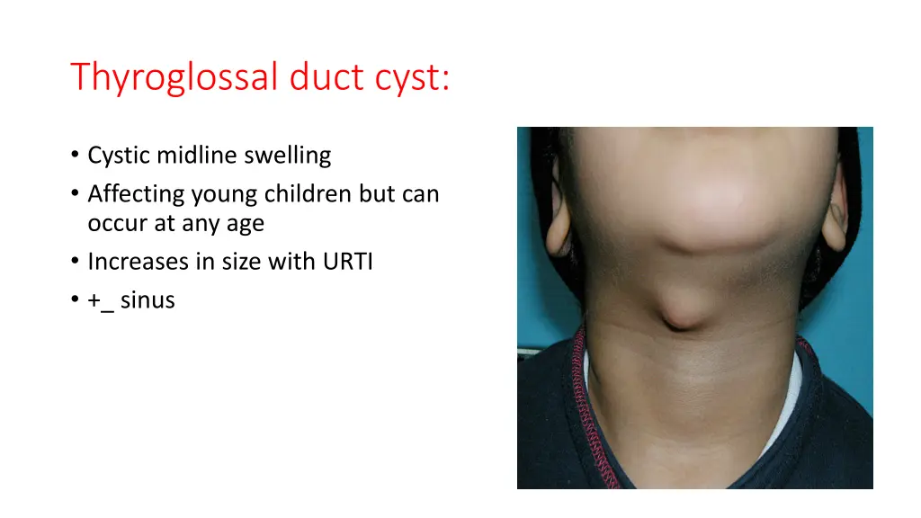 thyroglossal duct cyst