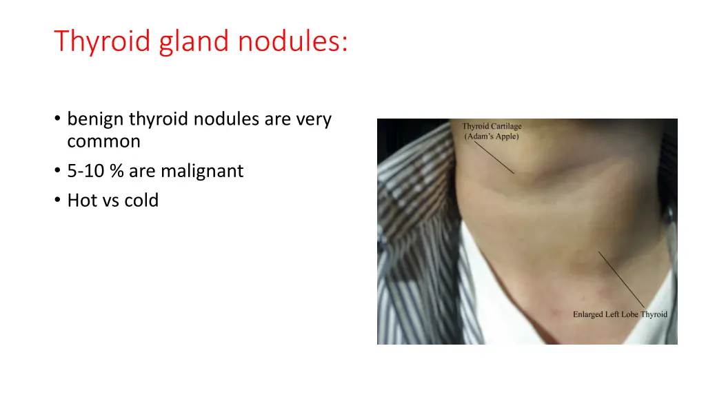 thyroid gland nodules