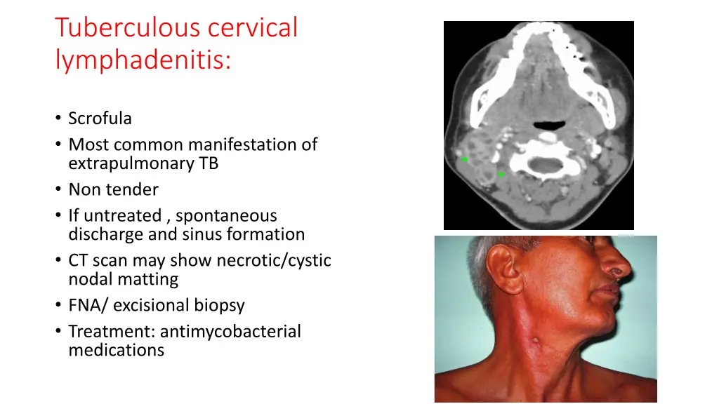 tuberculous cervical lymphadenitis