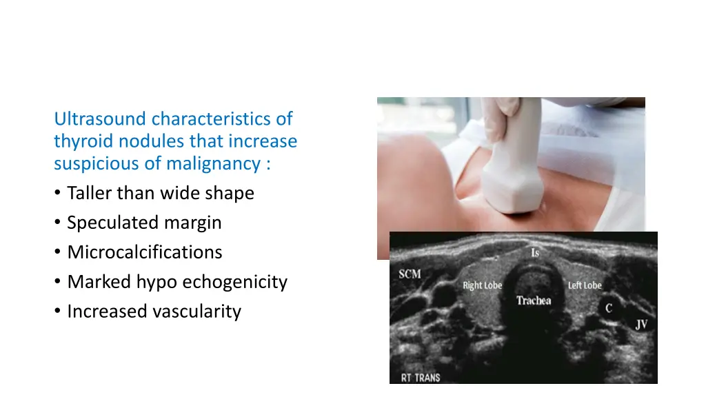 ultrasound characteristics of thyroid nodules