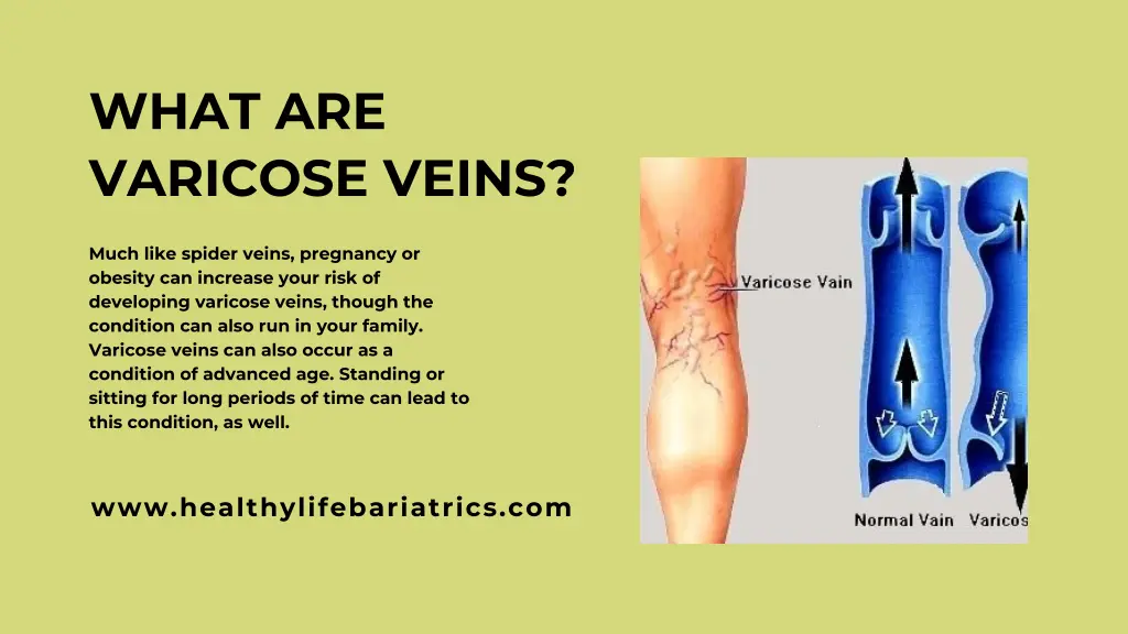 what are varicose veins