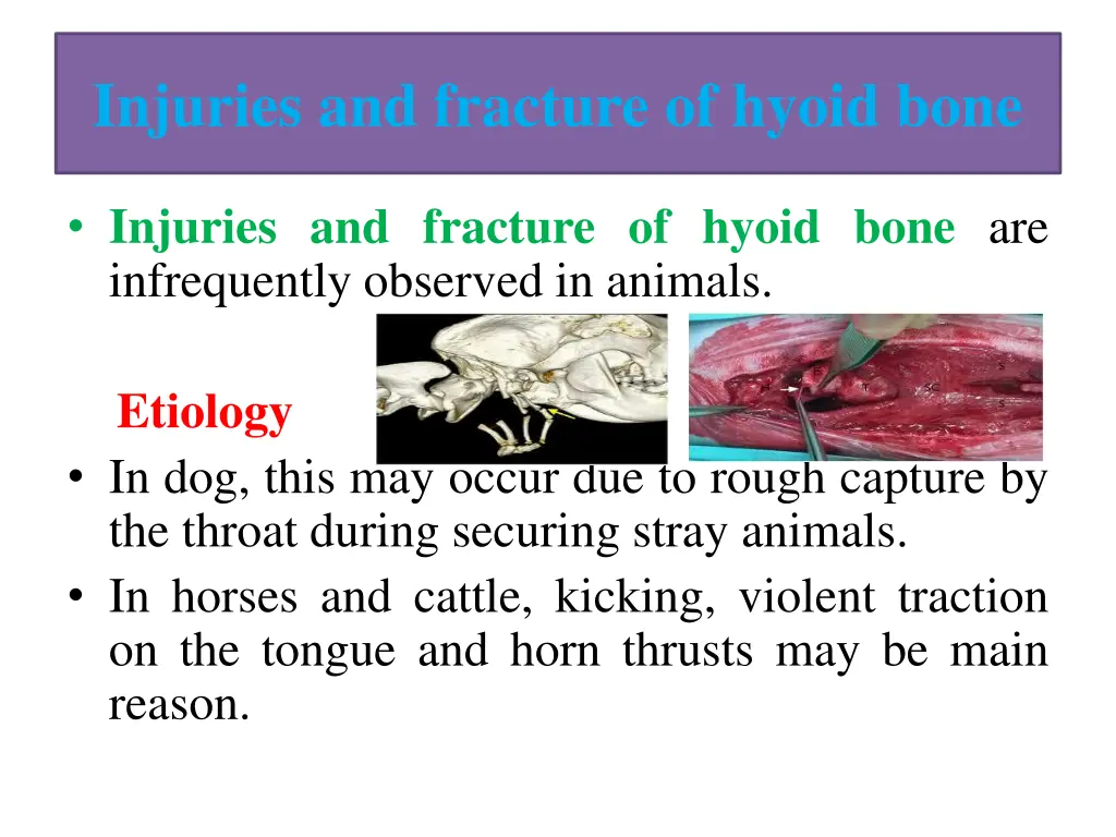 injuries and fracture of hyoid bone