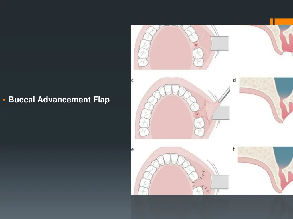 buccal advancement flap