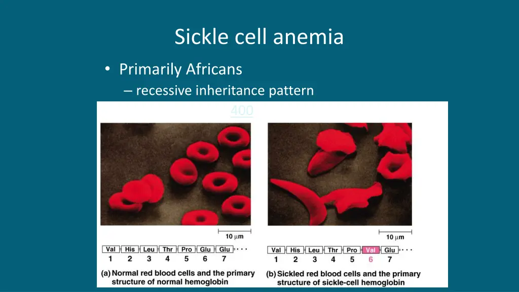 sickle cell anemia