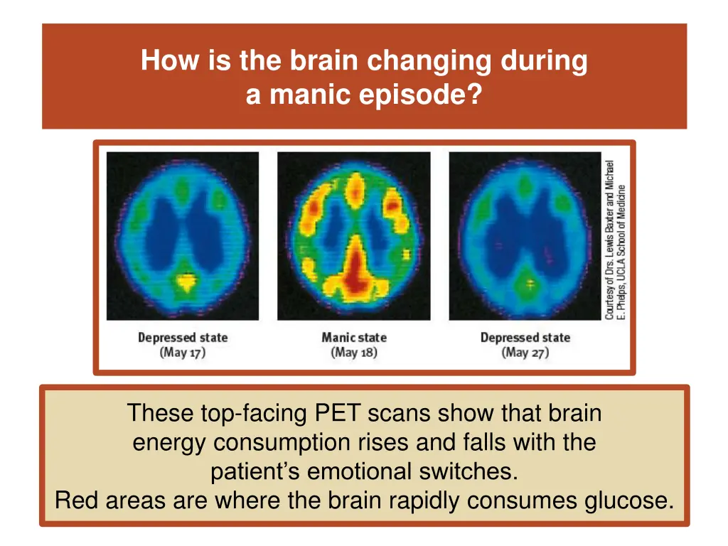 how is the brain changing during a manic episode