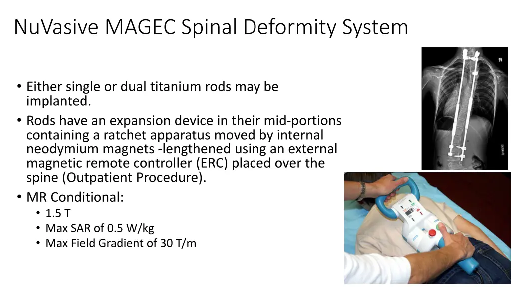 nuvasive magec spinal deformity system 1