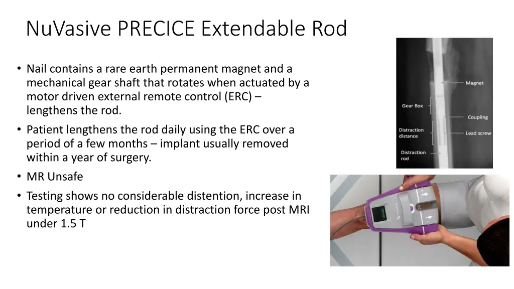 nuvasive precice extendable rod 1