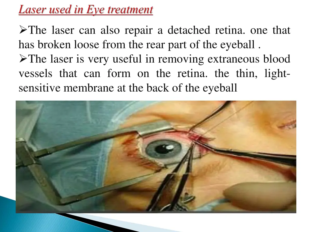 the laser can also repair a detached retina