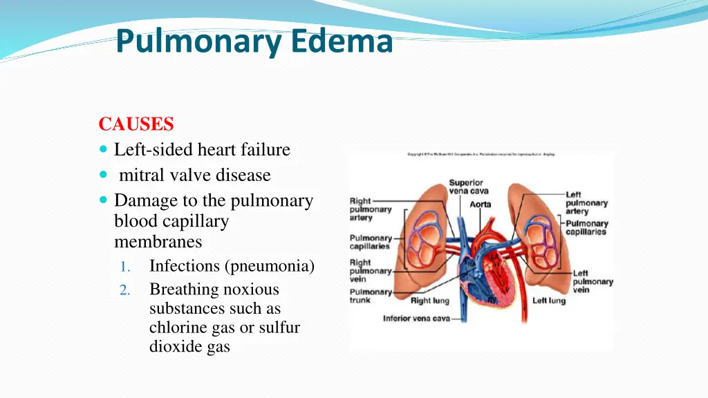 pulmonary edema