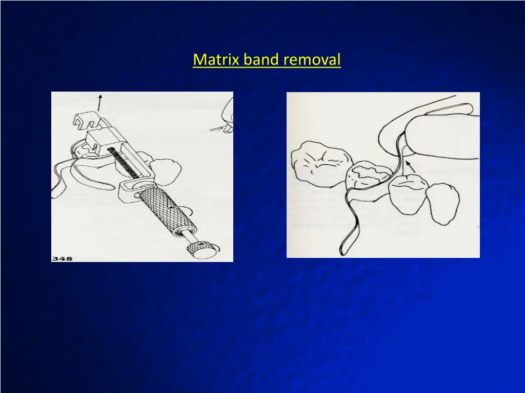 matrix band removal