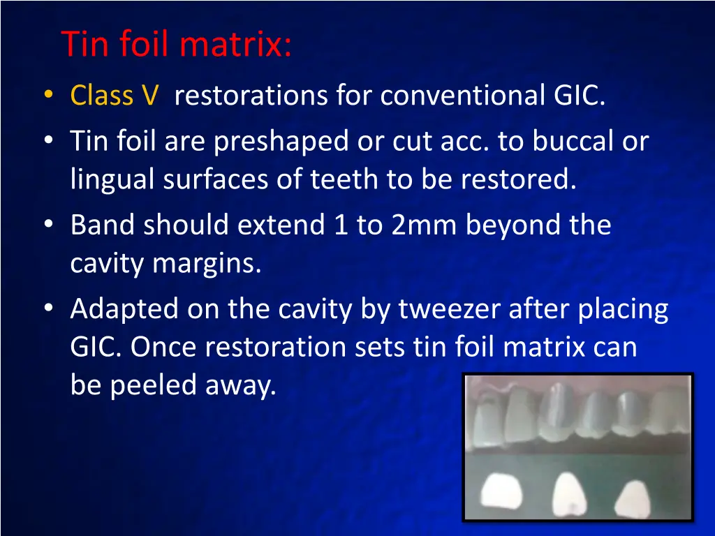 tin foil matrix class v restorations