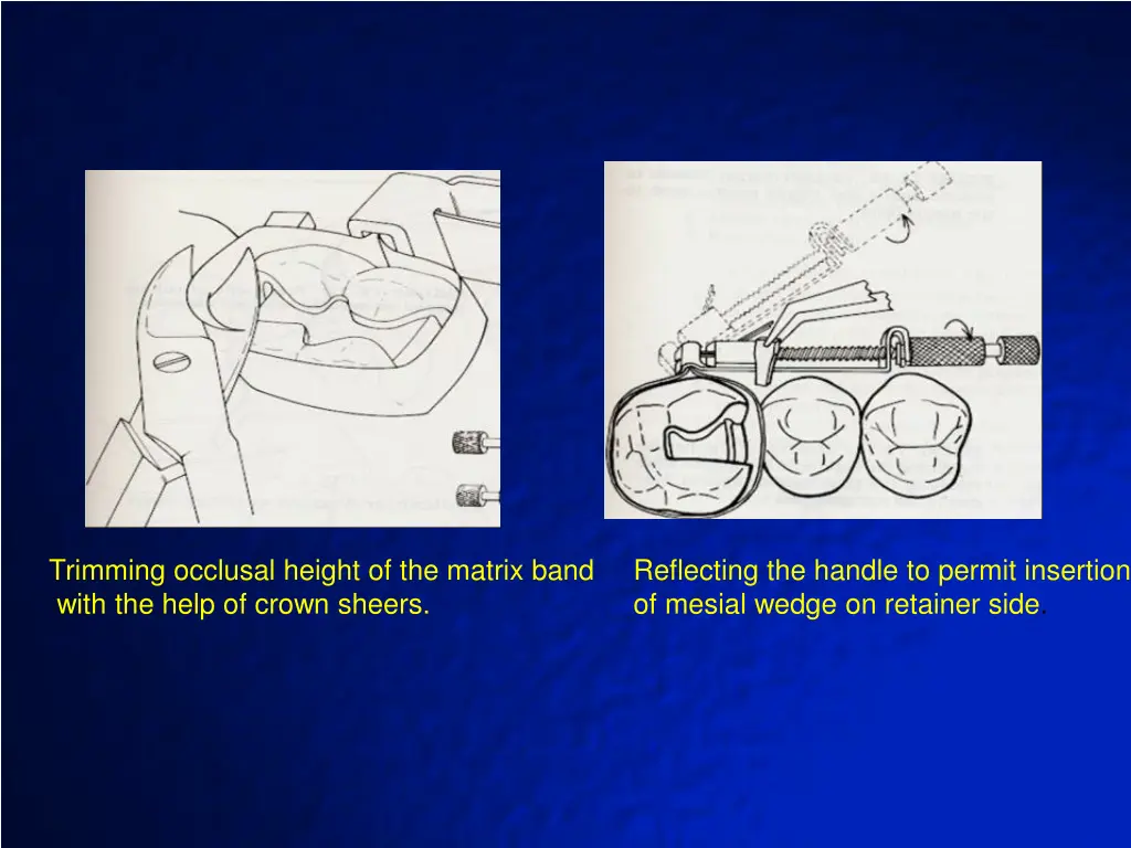 trimming occlusal height of the matrix band with