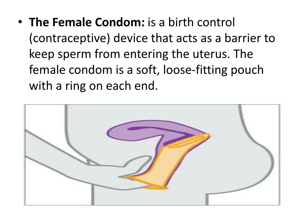 the female condom is a birth control