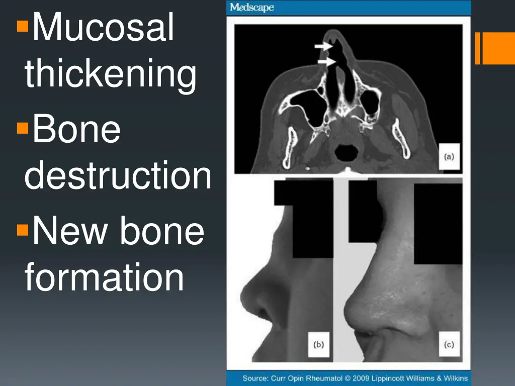 mucosal thickening bone destruction new bone