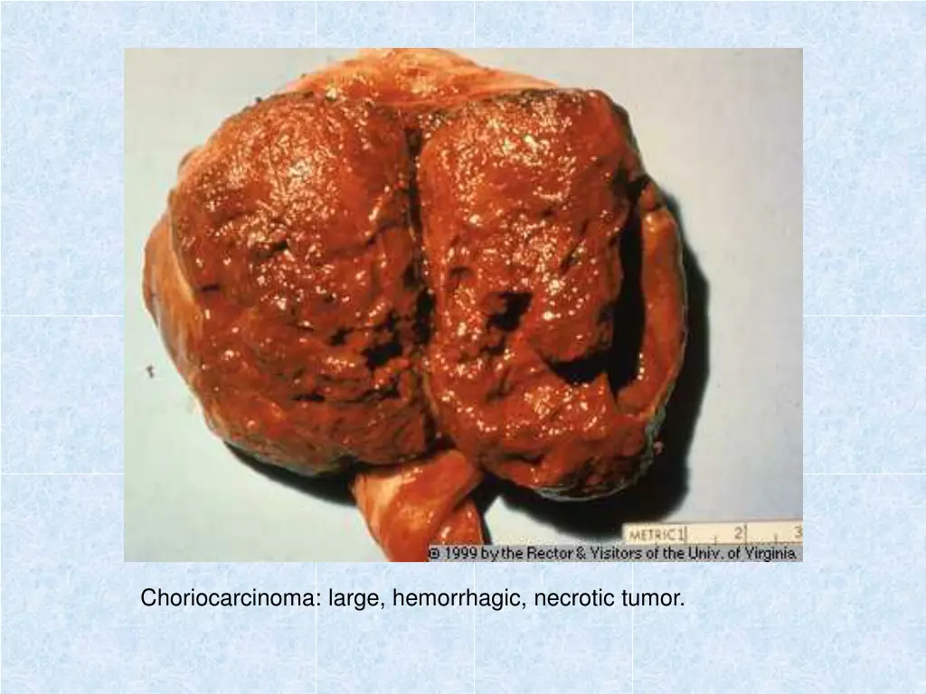 choriocarcinoma large hemorrhagic necrotic tumor