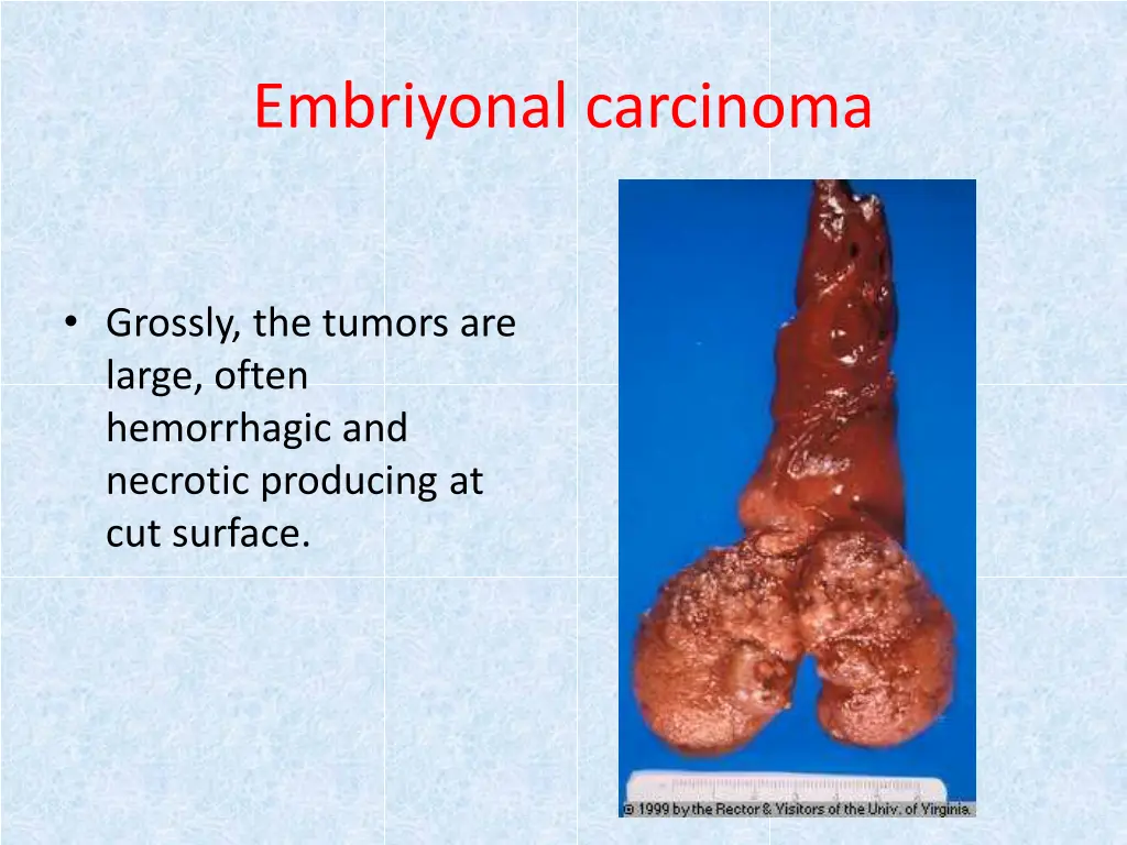 embriyonal carcinoma