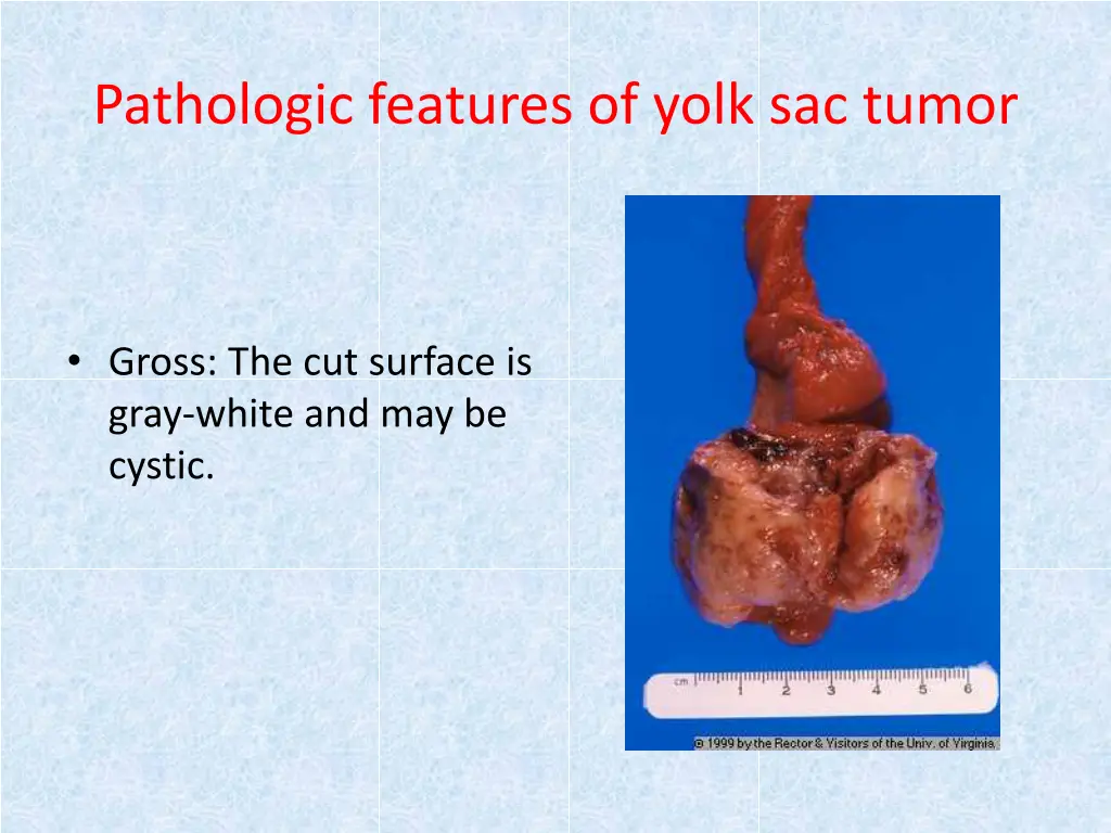 pathologic features of yolk sac tumor