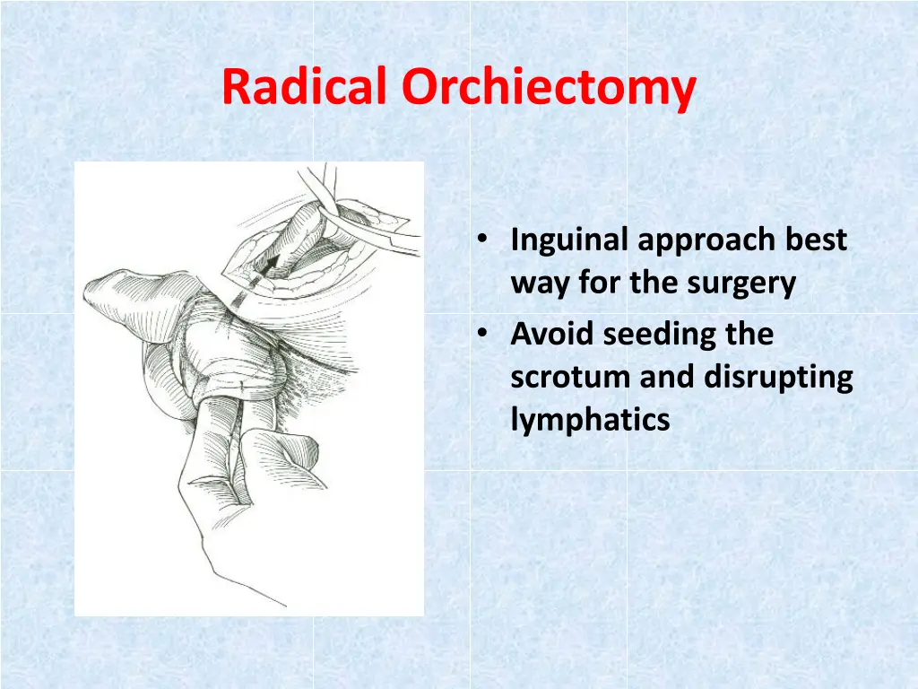 radical orchiectomy