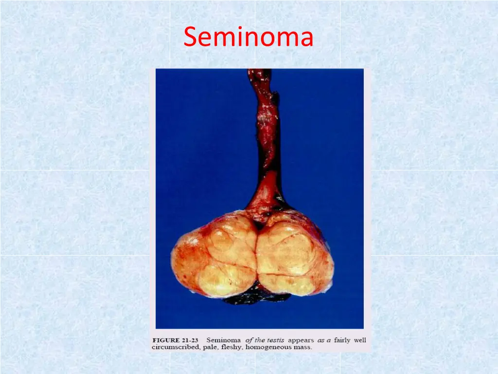 seminoma