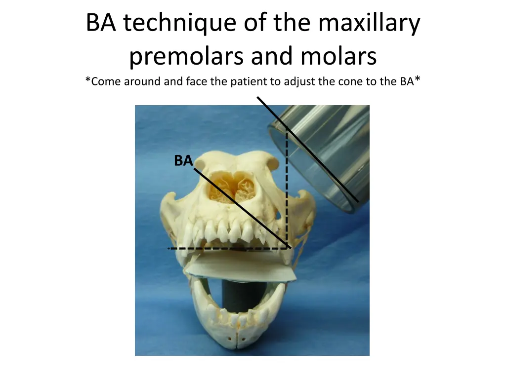 ba technique of the maxillary premolars