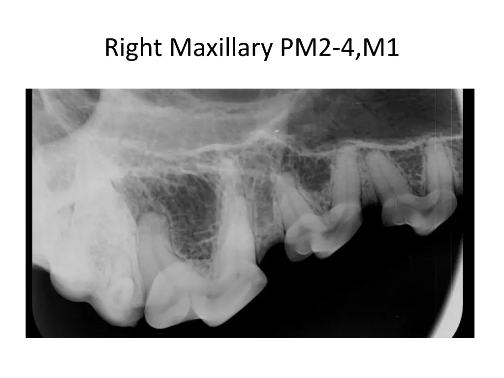 right maxillary pm2 4 m1