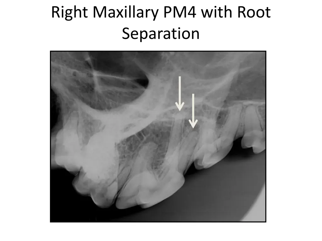 right maxillary pm4 with root separation