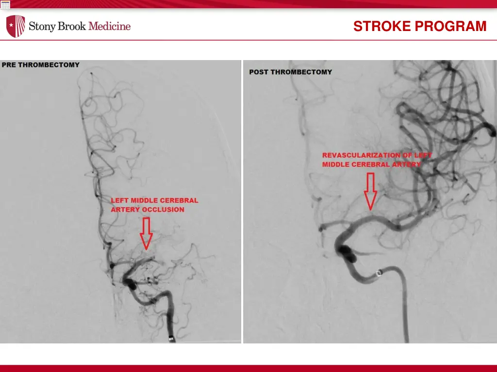 stroke program 1