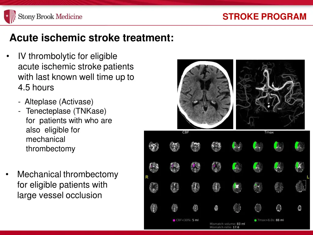 stroke program