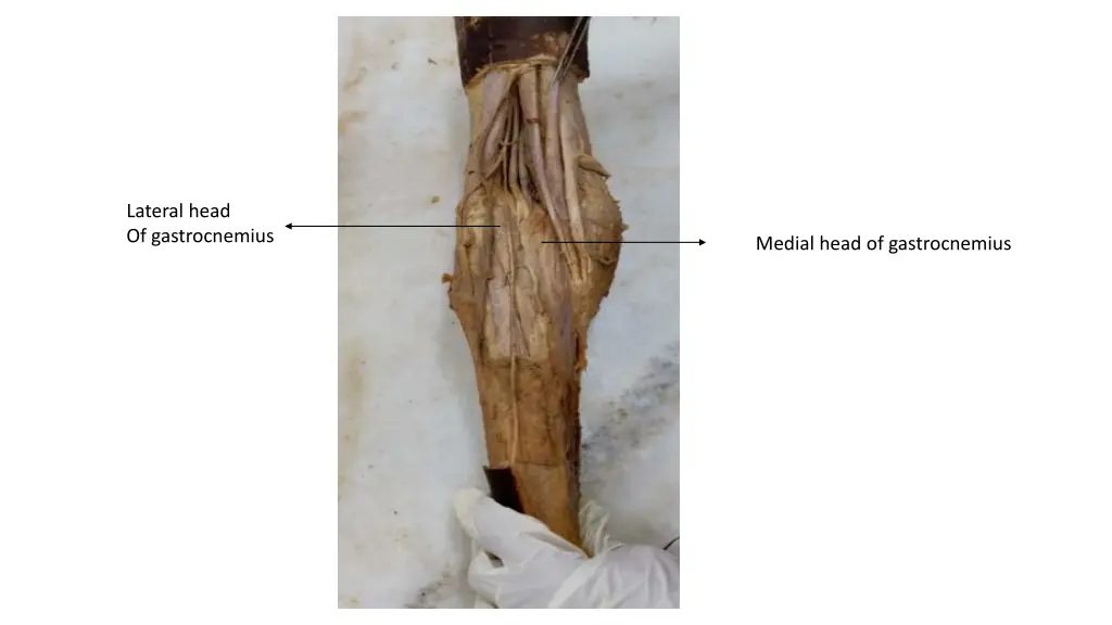 lateral head of gastrocnemius