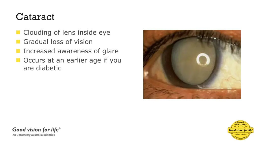 cataract