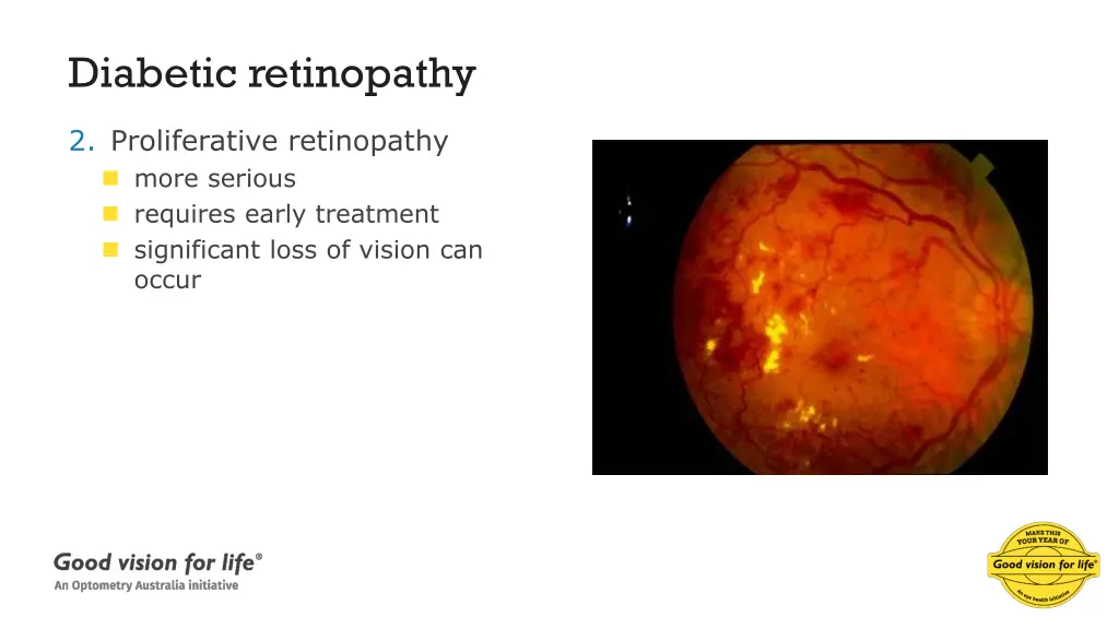 diabetic retinopathy 1